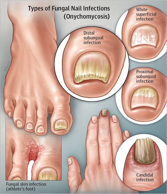 types pf toenail fungus